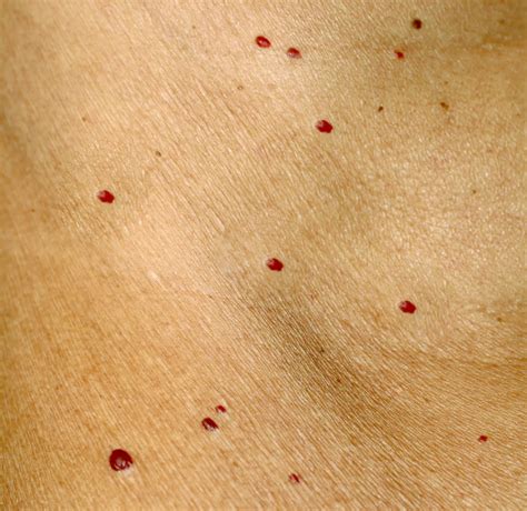 Tiny Red Spots On Skin Pictures Photos