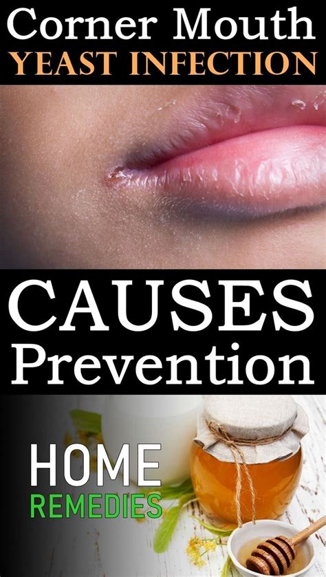 Yeast Infection On Corner Of Mouth Yeast Infection Yeast Infection Treatment Yeast Infection