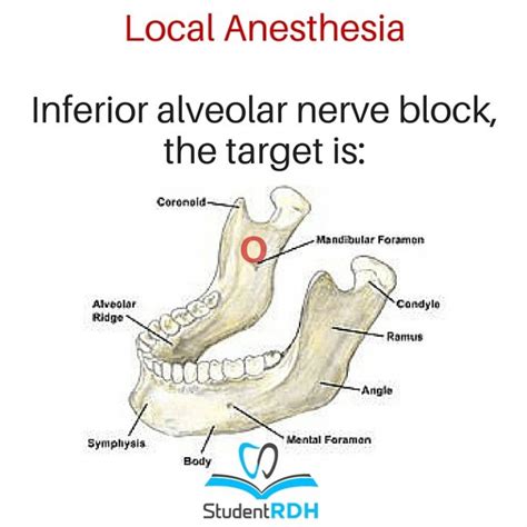 When Providing An Inferior Alveolar Nerve Block The