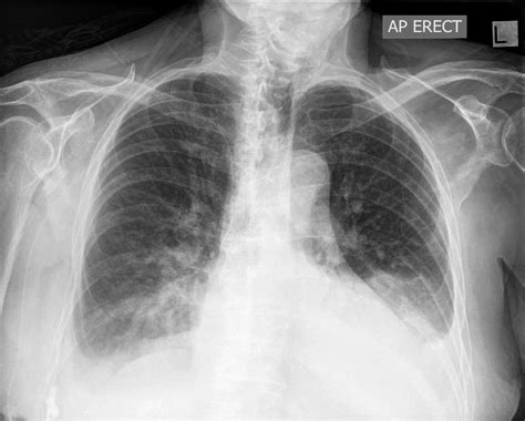 Pleural Effusions Pathogenesis And Anterior Posterior Chest X Ray