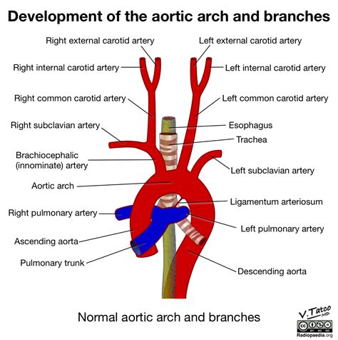 Radiopaedia Drawing Aortic Arch And Its Branches English Labels Anatomytool