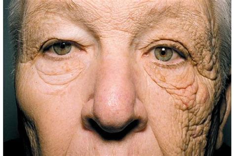 This Photo Shows What 28 Years Of Sun Damage Does To Your Face The