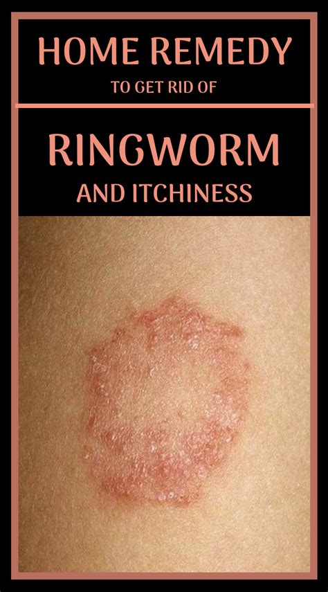 Home Remedy To Get Rid Of Ringworm And Itchiness Get Rid Of Ringworm