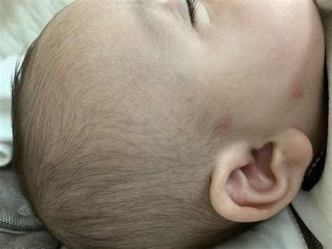 Red Spots On Babys Face Babycenter