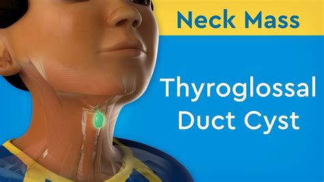 Neck Mass Thyroglossal Duct Cyst Youtube