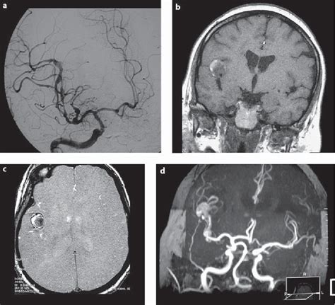Figure 1 From Middle Cerebral Artery Dissection Gives Rise To Giant