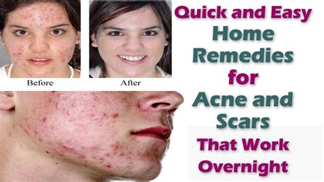 How To Get Clear Skin Remove Acne Scars Pimples At Home Naturally