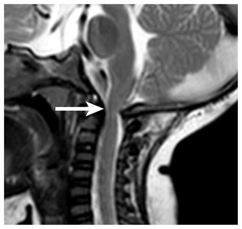 Foramen Magnum Stenosis In A 5 Month Old Boy With Achondroplasia Cmaj