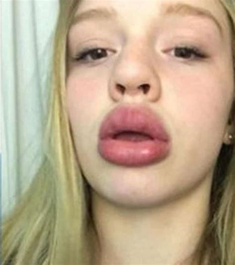 Reasons Why You Shouldnt Try The Kylie Jenner Lip Challenge LOOK The Trent
