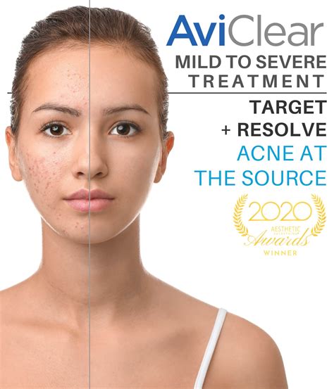 Aviclear Acne Treatment Baltimore