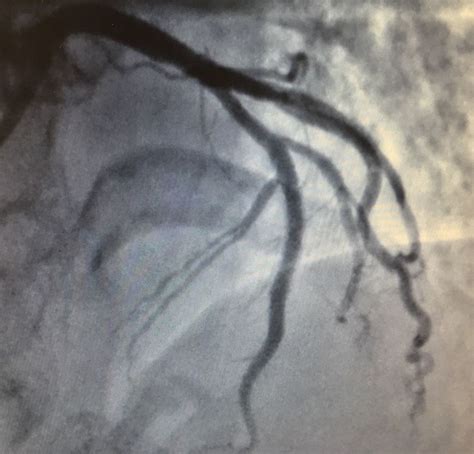 Coronary Angiography Invasive London Cardiac Clinic