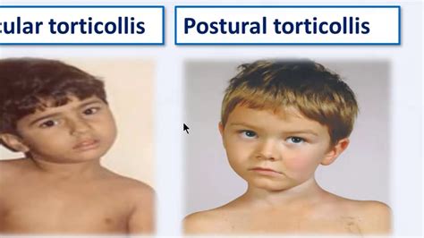 03 Congenital Muscular Torticollis Types Torticollis คือ Music Australia