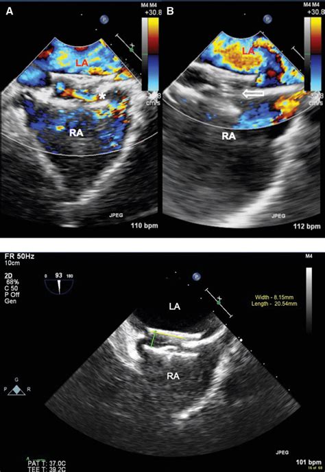 Figure 1 From Percutaneous Closure Of A Complex Intradevice Residual