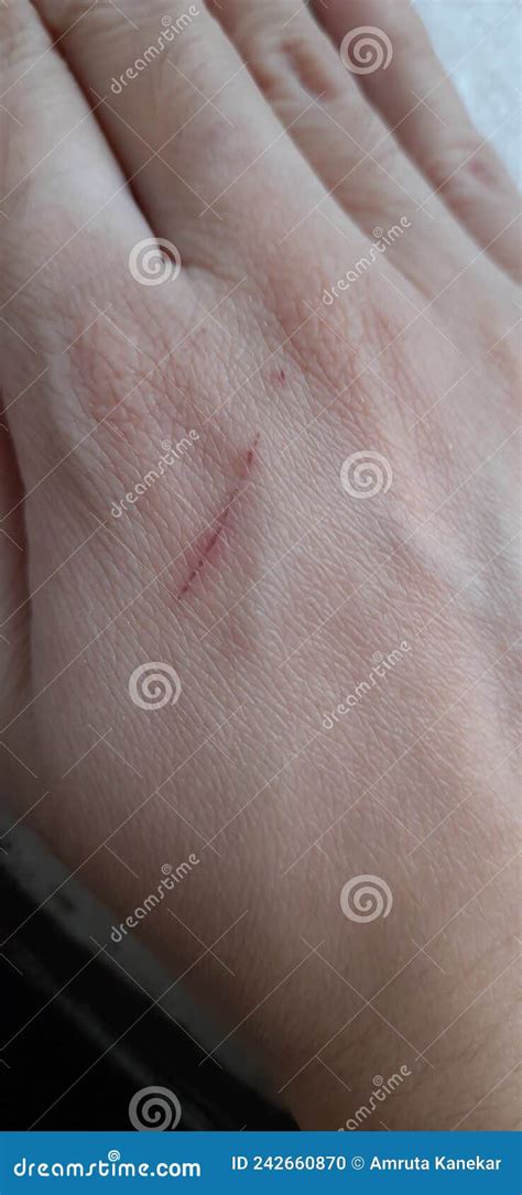 Scratch On Human Hand Healing Scar Stock Photo Image Of Palm Scar
