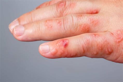 Scabies Canterbury Skin And Laser Clinic