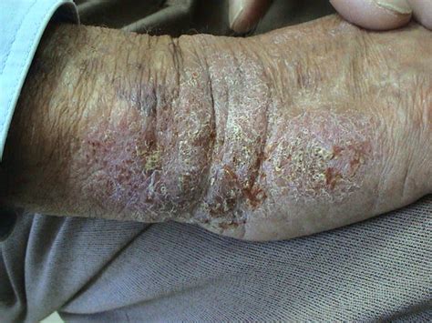 Dermatitis Ekzema Infected Eczema Picture Hellenic Dermatological
