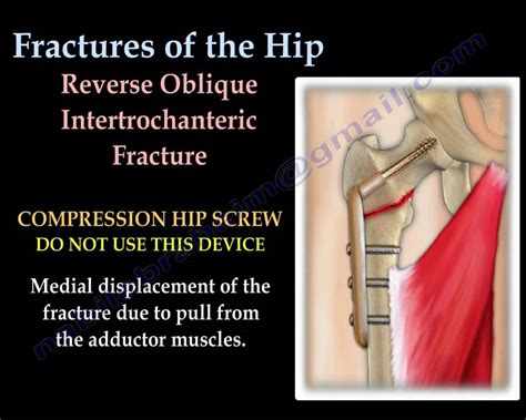 Fractures Of The Hip and its fixation - Everything You ...