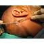 Case Example Sentinel Lymph Node Biopsy  Iowa Head And Neck Protocols