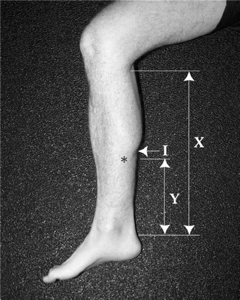 Gastrocnemius Indentation Due To The Muscle Belly Merging Into The