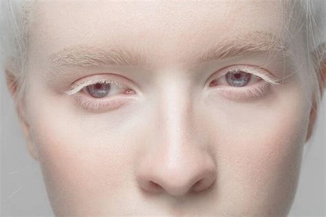 Albinismul Cauze Simptome Tratament Preturi Dr Max Sexiezpix Web Porn