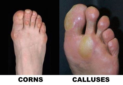 What does callus look like on feet? Corns And Calluses - Treatment and Home Remedies
