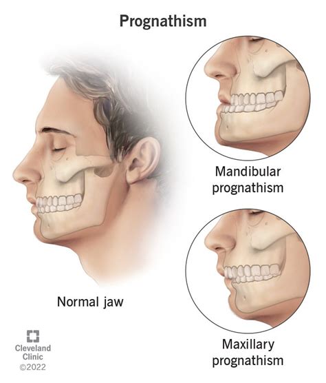 Prognathism Definition Causes And Treatment