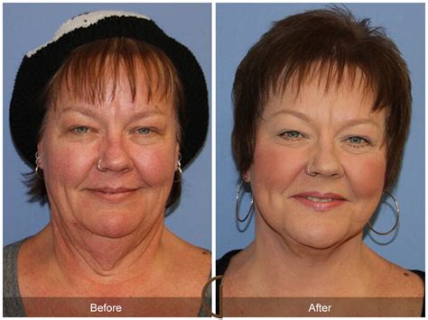 Neck Lift Before And After Photos Patient 25 Dr Kevin Sadati