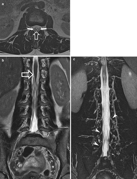 Spine Anatomy Radiology