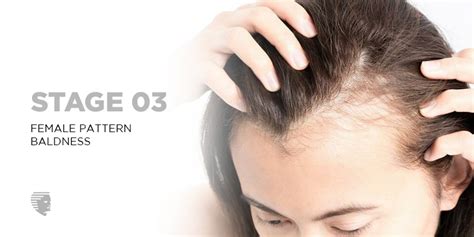 Female Pattern Baldness Symptoms Causes Treatment And Prevention