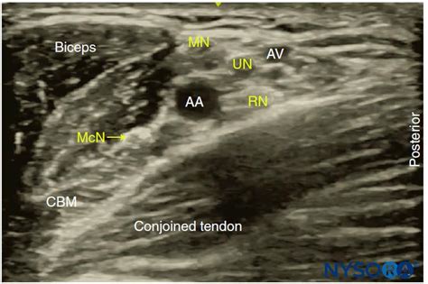 Ultrasound Guided Axillary Brachial Plexus Block Nysora