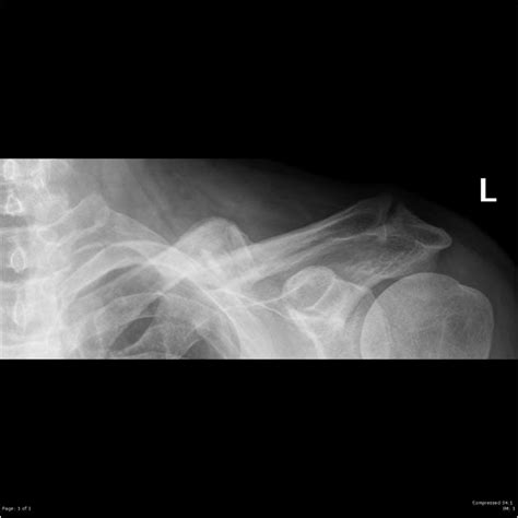 Clavicle Fracture Radiology Case