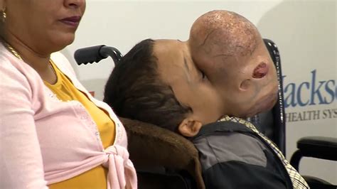 Doctors In Florida To Remove 10 Pound Tumor From Boys Face