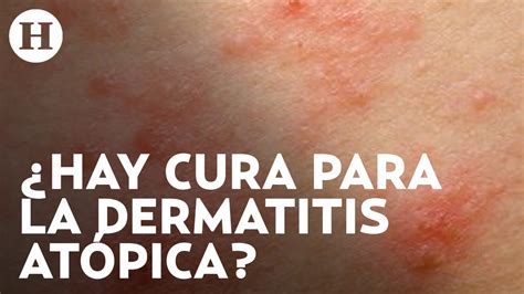 Dermatitis At Pica Qu La Causa Cu Les Son Los S Ntomas Y Qu