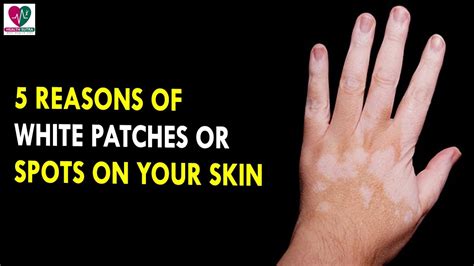 5 Reasons Of White Patches Or Spots On Your Skin Health Sutra Best