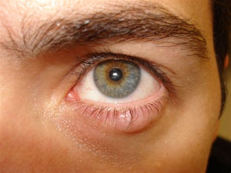 Eyelid Lumps And Lesions The Bmj
