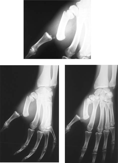 Posteroanterior And Oblique View Radiographs Of The Wrist And Hand