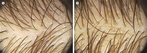 Finasteride Treatment Of Female Pattern Hair Loss Jama Dermatology
