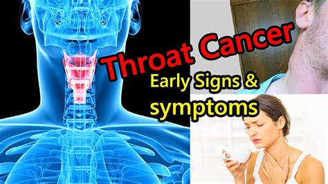 What Are The Symptoms Of Throat Cancer Throat Cancer Symptoms Youtube