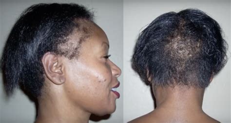 7 Ways To Grow Your Edges Back And Treat A Thinning Hairline