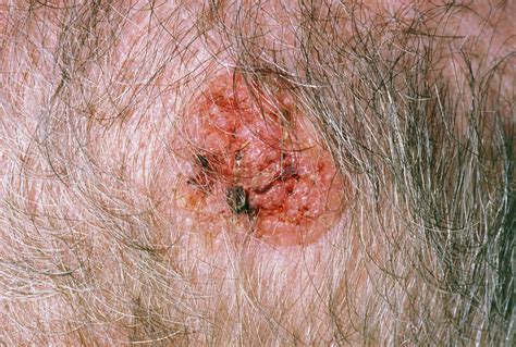 Squamous Cell Carcinoma On Scalp Stock Image M1310265