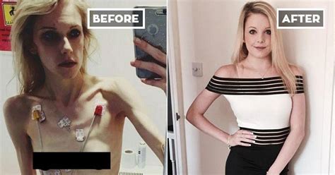 These Before And After Images Of People Who Overcame Anorexia Are