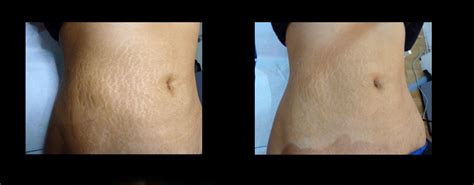 Before And After Photographs Following Enerjet Procedure For Stretchmarks