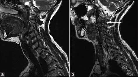 Occipital Neuralgia Secondary To Unilateral Atlantoaxial Osteoarthritis