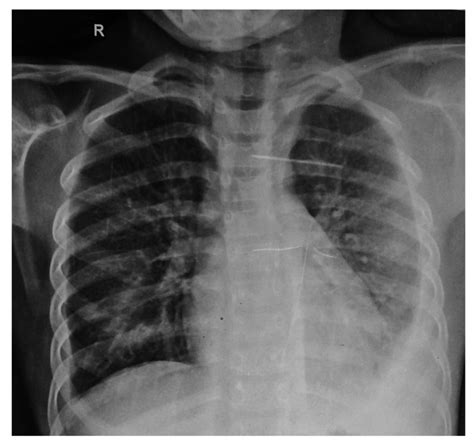 Chest X Ray Of Case 3 Showing Pericardial Effusion And Left Sided