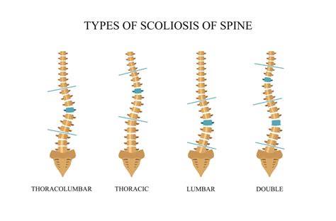 Scoliosis What Is It Symptoms Diagnosis Treatment