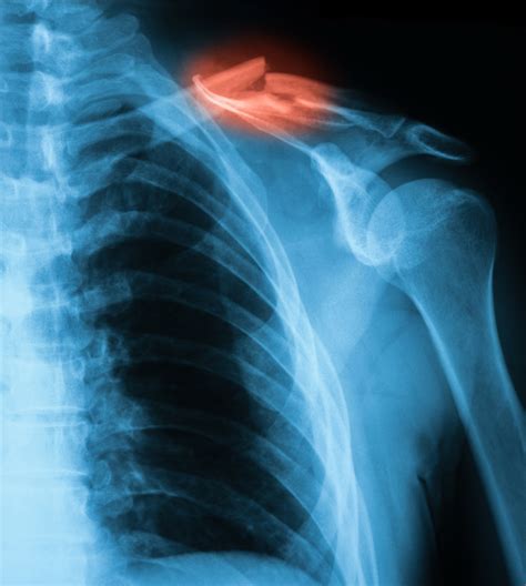 What Do You Do for a Broken Collarbone? | The Bone & Joint ...