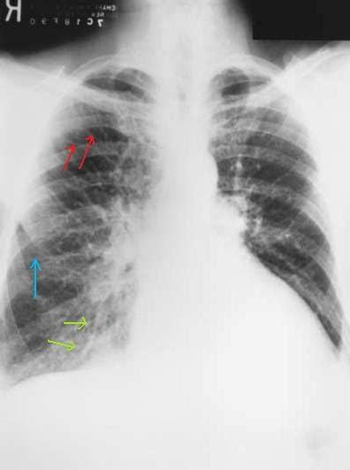 Kerley's b lines (white arrowheads) are short horizontal lines situated perpendicularly to the pleural surface at the lung base; Critical Care Medicine: Kerley's lines