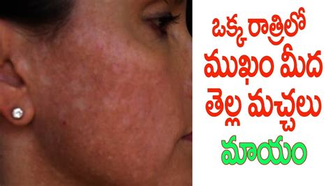 How To Get Rid Of White Spots Vitiligo On The Face Youtube