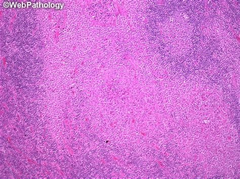 Webpathology A Collection Of Surgical Pathology Images