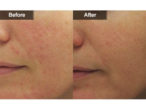 Red Spots And Vein Removal Mclean And Woodbridge Virginia Skin And Laser